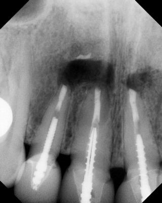 Apicoectomy - Surgical Root Canal