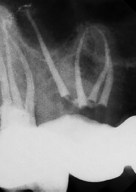 Root Canal - Access Through Crown