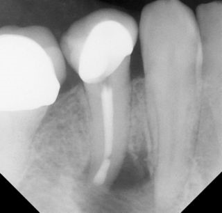 Apicoectomy - Surgical Root Canal