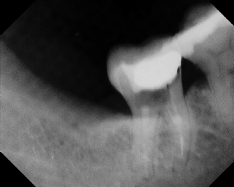 Root Canal - Broken Instrument Removal