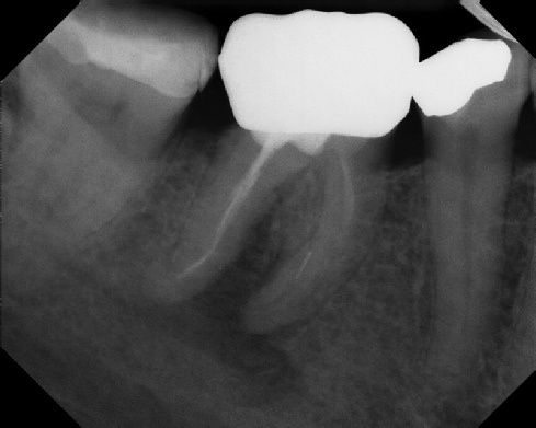 Root Canal - Broken Instrument Removal