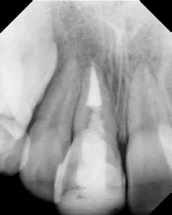 Root canal with large lesion - Meriden