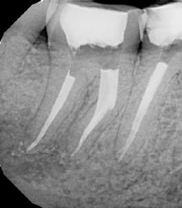 Root Canal - Broken Instrument Removal