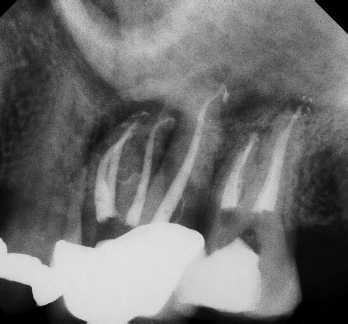 Root Canal - Access Through Crown