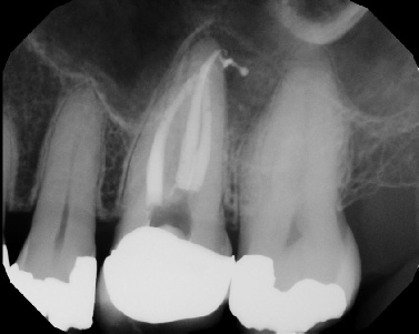 Root Canal Retreatment - Stratford