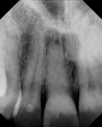 Root Canal with Calcified Canals - Stratford