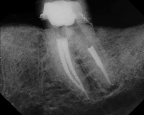 Root Canal - Broken Instrument Removal