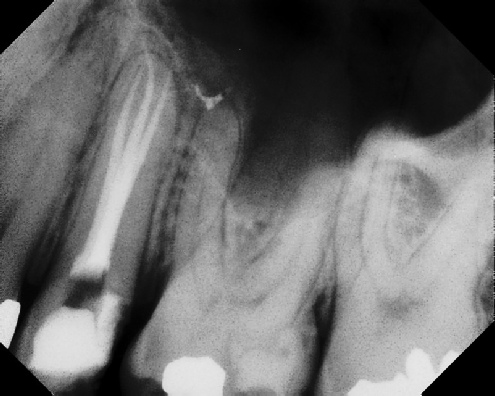 root canal anatomy - Stratford