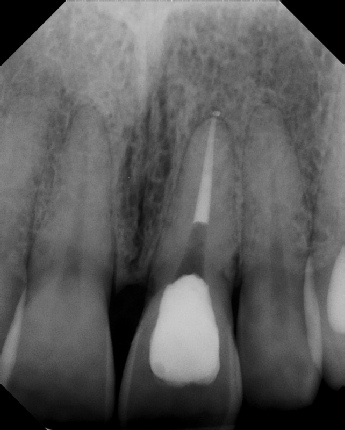 Root Canal with Calcified Canals - Meriden