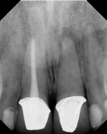 Root Canal with Calcified Canals - Meriden