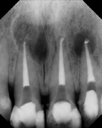 Root Canal - Broken Instrument Removal