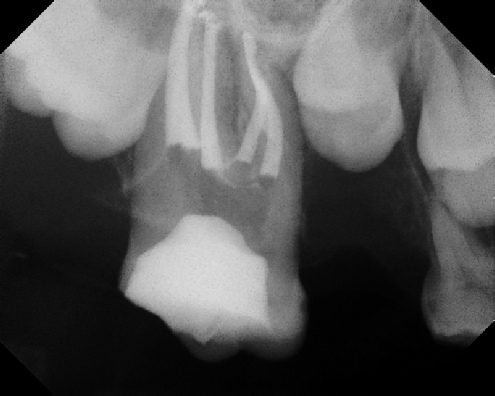 root canal anatomy - Meriden