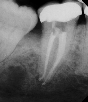 Root Canal - Access Through Crown