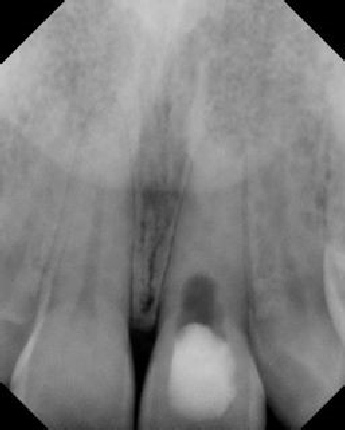 Root Canal with Calcified Canals - Stratford