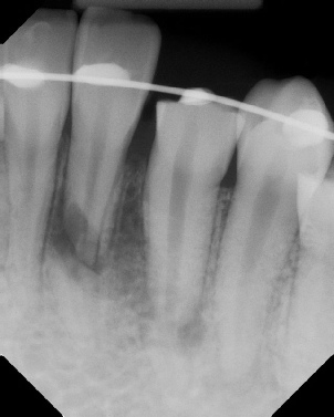 Apicoectomy - Surgical Root Canal