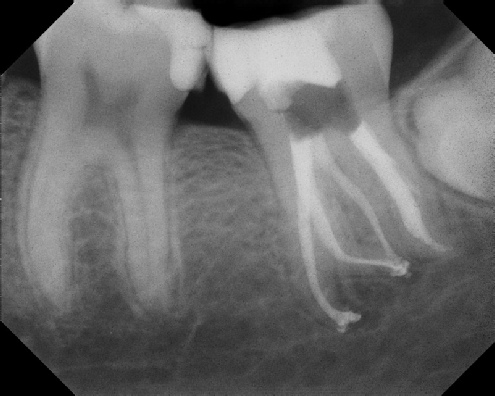 Root Canal Anatomy - Meriden