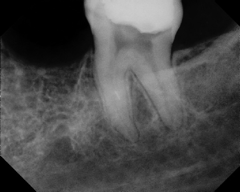 Root Canal - Broken Instrument Removal