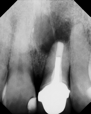 Apicoectomy - Surgical Root Canal