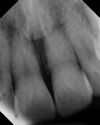 Root Canal with Calcified Canals - Meriden