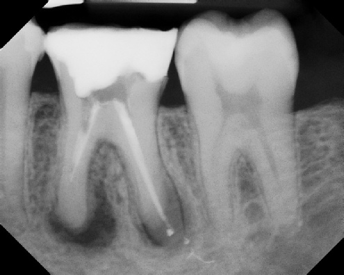 Root Canal Retreatment - Meriden