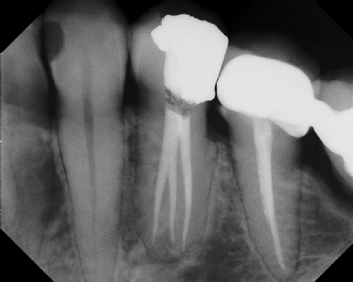 root canal anatomy - Stratford