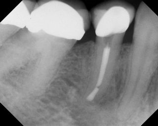 Apicoectomy - Surgical Root Canal