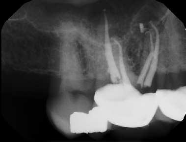 Root Canal - Access Through Crown