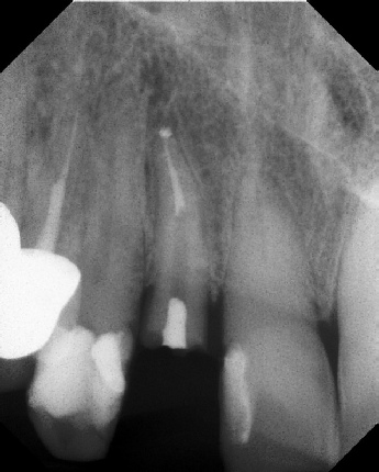 Root Canal with Calcified Canals - Stratford