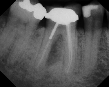 Root canal with large lesion - Meriden