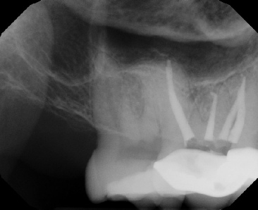 Root Canal - Access Through Crown