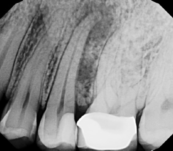 Root canal with large lesion - Stratford