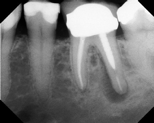 Root Canal Retreatment - Stratford