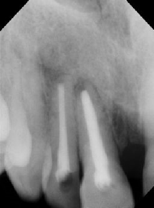 Root canal - Apexification