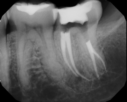 root canal anatomy - Stratford