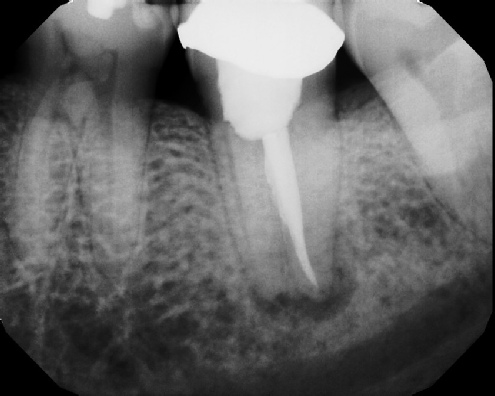 Root Canal Retreatment - Meriden