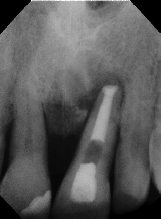 Root canal - Apexification