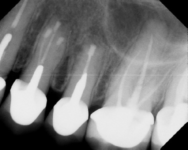 Apicoectomy - Surgical Root Canal