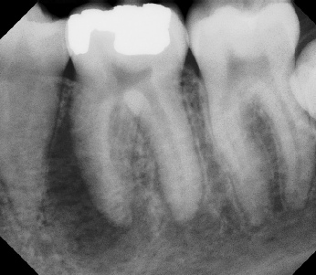 Root canal with large lesion - Stratford