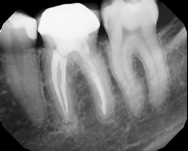 Root canal with large lesion - Stratford