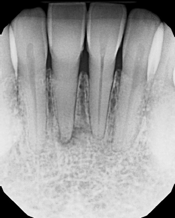 Root Canal with Calcified Canals - Meriden