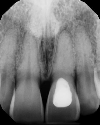 Root Canal with Calcified Canals - Meriden