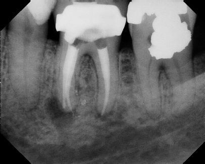 Root Canal - Broken Instrument Removal