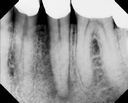 Root canal with large lesion - Stratford