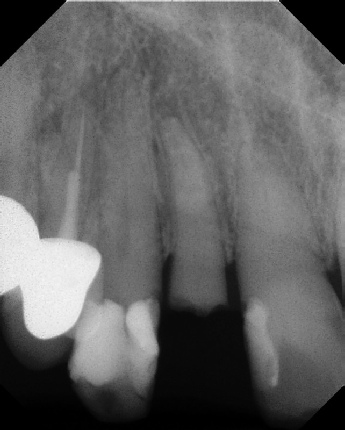 Root Canal with Calcified Canals - Stratford