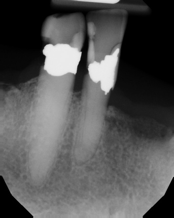 Root Canal with Calcified Canals - Meriden