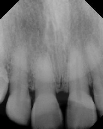 Root Canal with Calcified Canals - Stratford