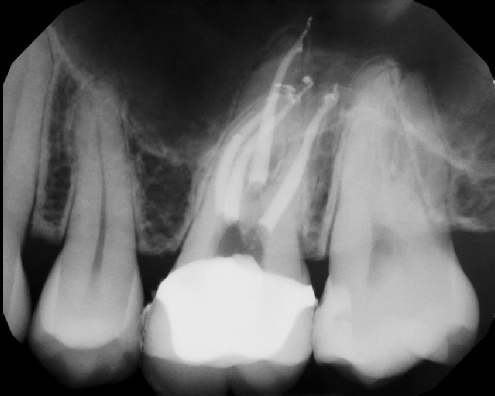 root canal anatomy - Meriden