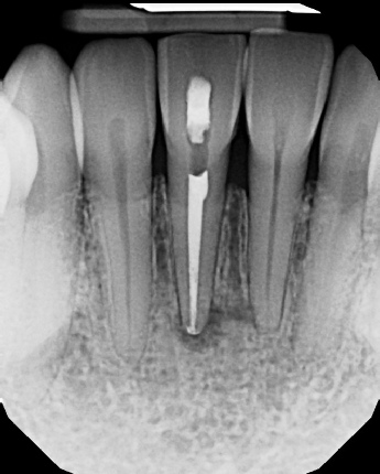 Root Canal with Calcified Canals - Meriden