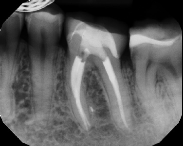 Root canal with large lesion - Stratford