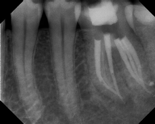 root canal anatomy - Meriden